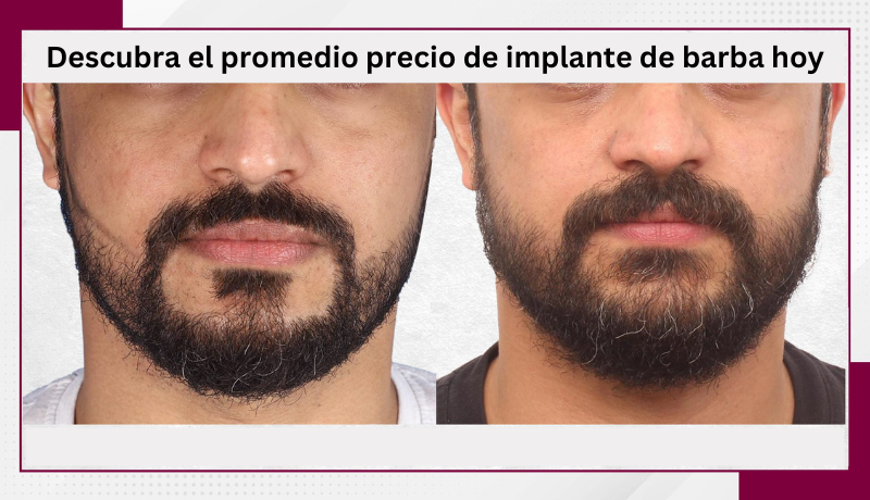 precio de implante de barba